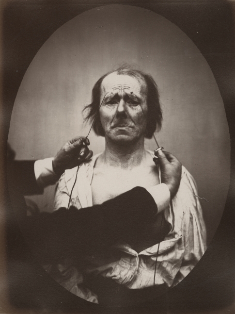 DUCHENNE DE BOULOGNE and Adrien TOURNACHON (French, 1806-1875 & 1825-1903) Profound suffering, with resignation, , 1862, negative, circa 1856 Albumen print from a glass negative 22.4 x 16.6 cm oval on 22.7 x 17.2 cm paper, mounted on 41.0 x 27.5 cm paper "20" in pencil on mount. "Fig 20" in pencil on mount verso.